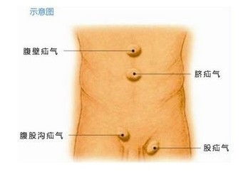 疝气手术后注意事项？